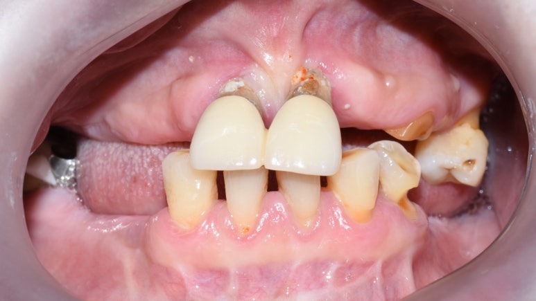 사용중인 틀니가 불편하다면? 임플란트와 틀니가 결합된 임플란트 틀니 추천 관련 이미지 1