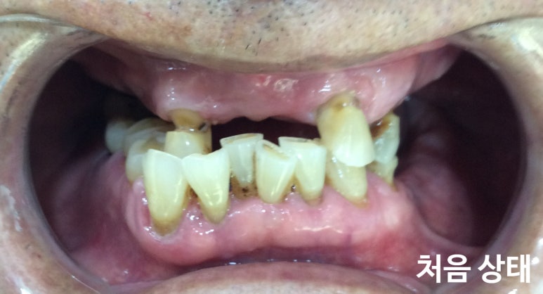 [시청역/서울역/광화문] 전체 임플란트 사례사진, 틀니대신 임플란트 관련 이미지 2