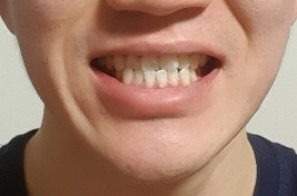 서울역 치과 투명교정 실제사례,비용가격 알아볼까요? 관련 이미지 5