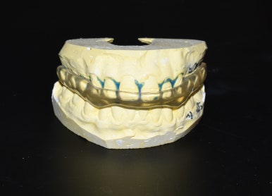 [서울/시청역] 이갈이소리녹음,이갈이장치소개, 이갈이치료방법, 가격 관련 이미지 4