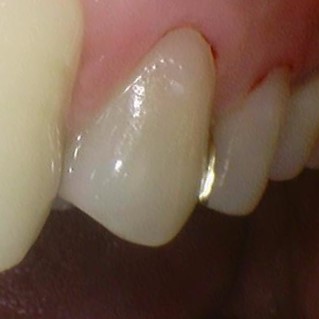 광화문 치료 치아에 까만 점이 생겼어요 관련 이미지 3