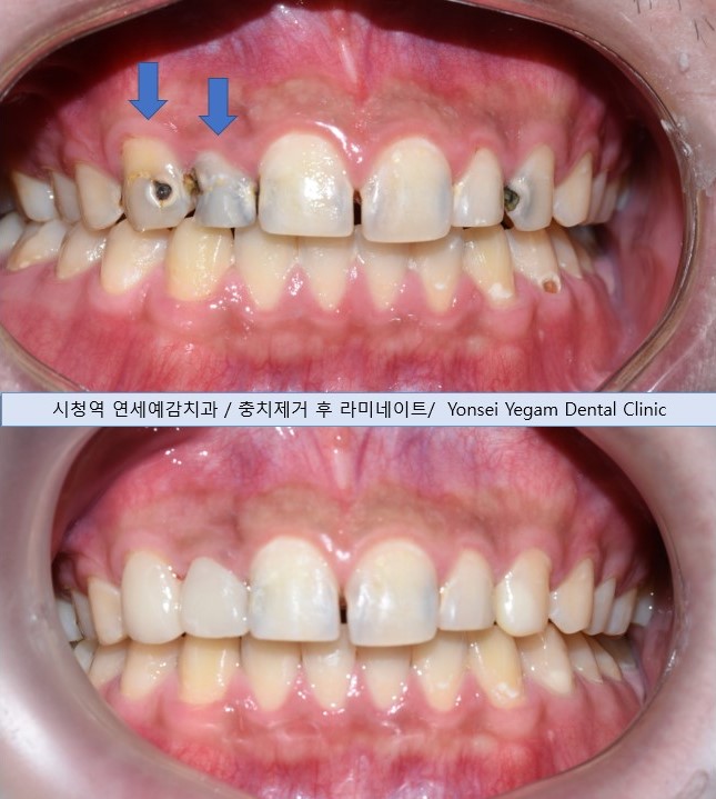앞니가 변색이 있어서 크라운을 해야하는데 뒤에 교정 유지장치가 붙어있다면? 관련 이미지 5