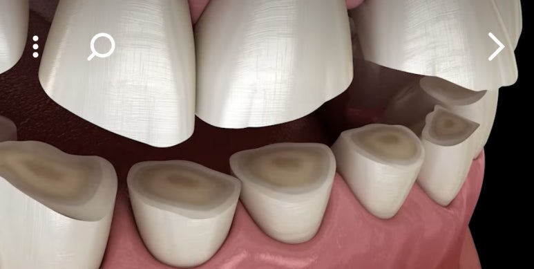 Do You Only Need Botox in the Jaw? When Temporal Muscle Botox May Be Needed—Costs Also Provided by a Dental Clinic at City Hall Station image 2