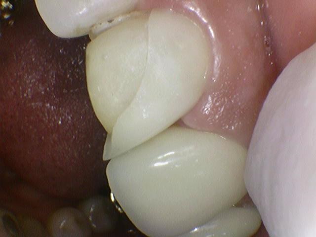앞니 하나가 부러졌어요 앞니 크라운 앞니 브릿지 관련 이미지 4