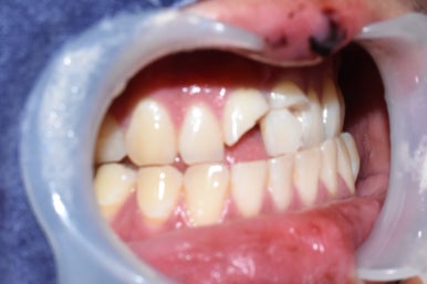 넘어져서 또는 부딪혀서 앞니 아주 많이 부러진 경우, 시청역치과 실제 앞니브릿지케이스 관련 이미지 11