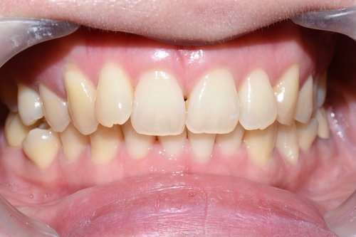 [시청역/광화문/서대문]삐뚤삐뚤한 치아 무삭제라미네이트로 치아성형 관련 이미지 2