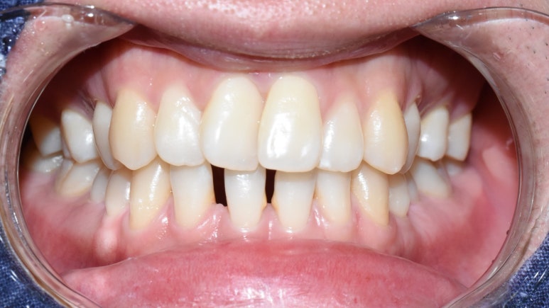 "아래 앞니 벌어진 틈 레진 하고 싶어요" &rarr;치료후 "(감쪽같아서) 어디를 했는지 모르겠어요" 관련 이미지 1