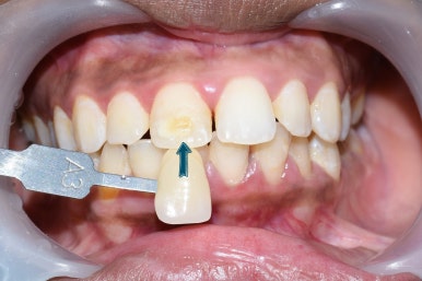 서울시청역 앞니 치아에 갈색 점, 흰색점 치료 전후 관련 이미지 6