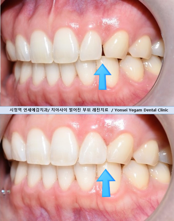 왜소치 치아사이틈 막기 올해는 치료받으세요! [무삭제라미네이트 케이스] 관련 이미지 13