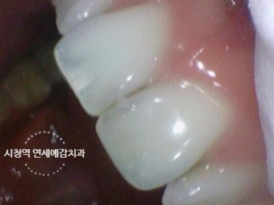 해외에서도 찾아오는 앞니레진치료, 광화문 시청역 서울역 근처 연세예감치과 외국인도 찾는 이유 관련 이미지 6