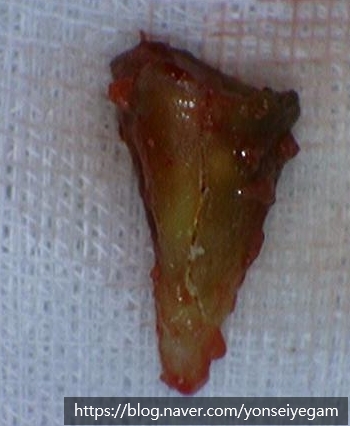 시청역치과 충치치료, 많이 썩었을 때? 신경치료에 대해 알아보아요 관련 이미지 5