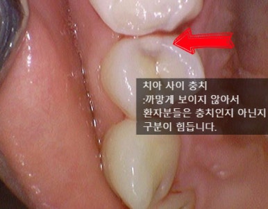 충정로 치과 인레이 해야한다고 들었는데 충치가 안보여요 관련 이미지 2
