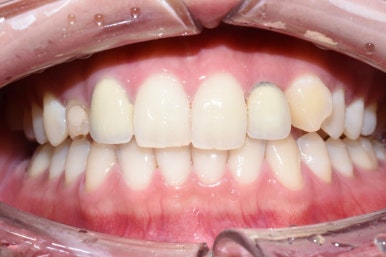 [광화문/시청역 치과]임플란트+크라운 +무삭제 라미네이트 복합 혼합 "6개 앞니 케이스" 소개/라미네이트가격 관련 이미지 1