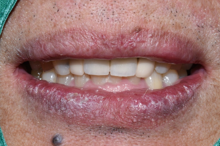 [서울시청역/서울역] 앞니 임플란트 가능할까요? 앞니 내비게이션임플란트 관련 이미지 11