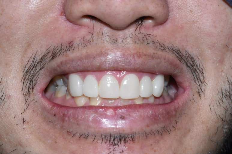 외국인환자의 왜소치 및 치아사이 공간으로 인한 서울 무삭제 라미네이트 & 최소삭제라미네이트 6개 케이스 치아전후사진 이벤트비용 관련 이미지 7