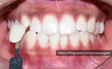 커피많이드세요? 치과에서 하는 치아미백 알려드려요[효과, 유지 등등 실제사례] 관련 이미지 13