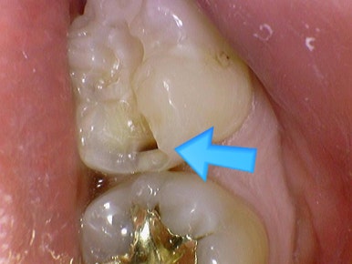 보여주는 충치치료, 믿고 치료받으세요. 서울시에서도 인증한 해외에서도 찾아오는 시청역치과 관련 이미지 6