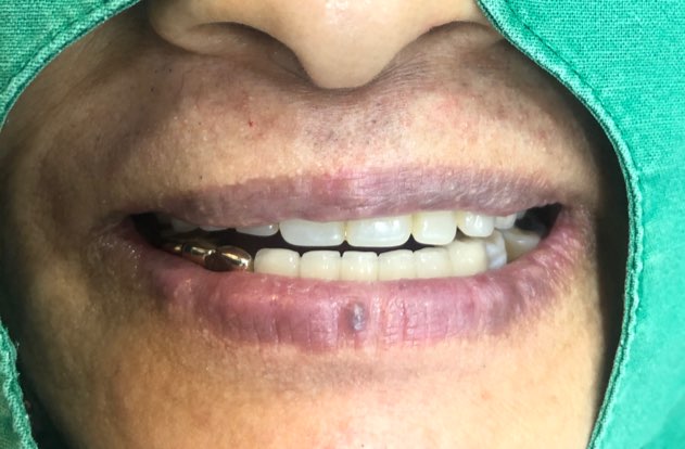 사용중인 틀니가 불편하다면? 임플란트와 틀니가 결합된 임플란트 틀니 추천 관련 이미지 14