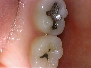 광화문/시청역"까만 아말감, 금니가 보기 싫다면?" 관련 이미지 5