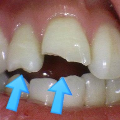 앞니 하나가 부러졌어요 앞니 크라운 앞니 브릿지 관련 이미지 1