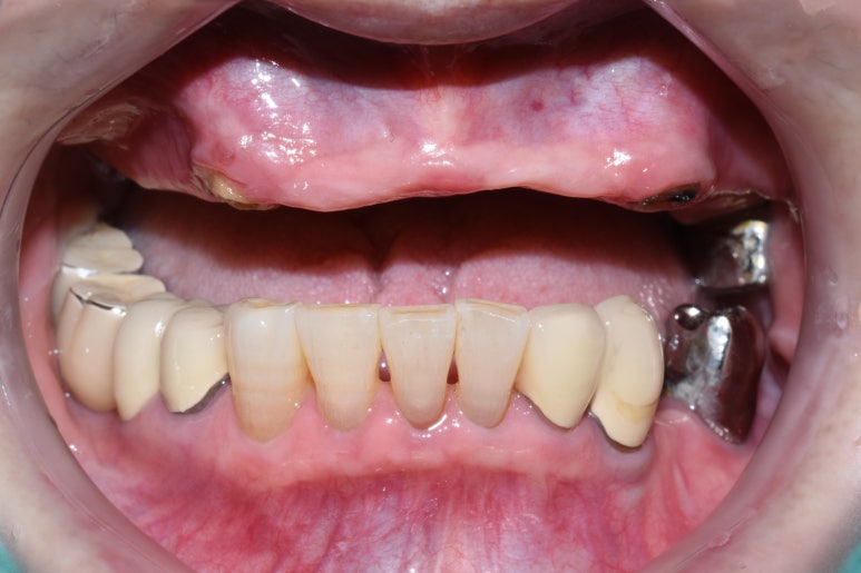 사용중인 틀니가 불편하다면? 임플란트와 틀니가 결합된 임플란트 틀니 추천 관련 이미지 7