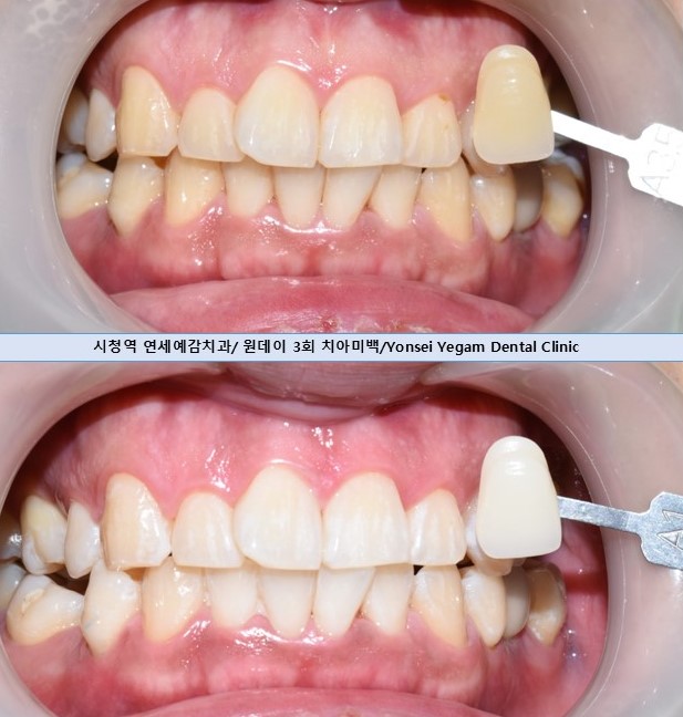 서울시청 용산 치아미백 잘 하는 치과, 예비신랑신부, 외국인, 교포들이 일부러 치아미백하러 찾아오는 치과 관련 이미지 5