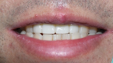 넘어져서 또는 부딪혀서 앞니 아주 많이 부러진 경우, 시청역치과 실제 앞니브릿지케이스 관련 이미지 4