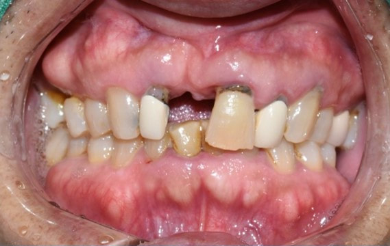 만65세이상 중 의료급여1종 보험임플란트 얼마일까요? 비용안내, 조건안내 관련 이미지 3