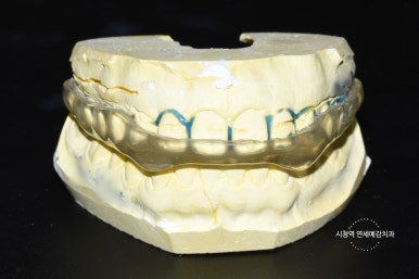 이갈이로 인한 치아 닳음 치료방법 비용 알아보아요 관련 이미지 3