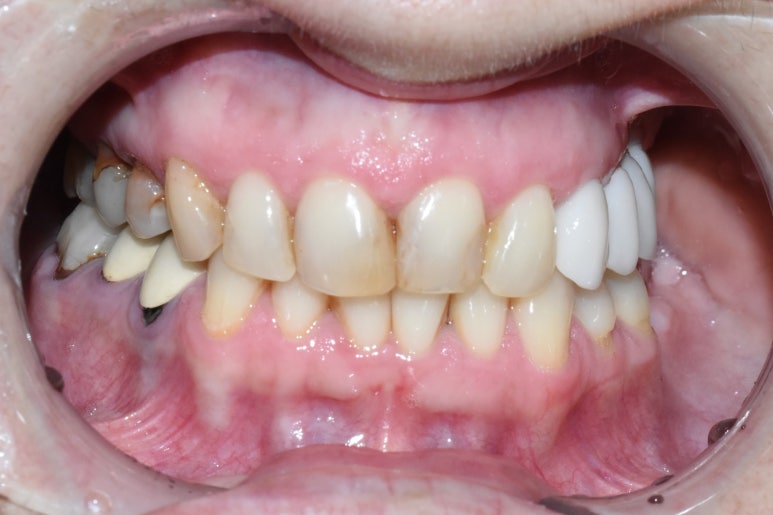 치아를 하얗게 하고 싶은 캐나다에서 오신 환자분의 라미네이트 사진공개이벤트진행중 관련 이미지 3