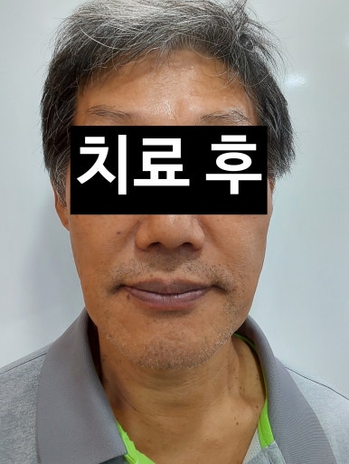 서울 중구 치과/이가 하나도 없는 환자의 치료방법/틀니, 풀아치임플란트, 전체 임플란트 등 관련 이미지 7