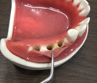 시청역 연세예감치과 디지털임플란트우수시술병원 선정 & 네비게이션 임플란트 관련 이미지 2