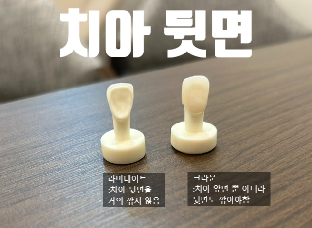앞니 깨짐 라미네이트로 크라운 보다 치아 덜 깎고 해결한 케이스 이벤트비용 가격까지 알려드려요 관련 이미지 6