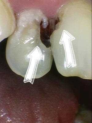 앞니가 너무 많이 썩었어요 앞니 충치치료 관련 이미지 3