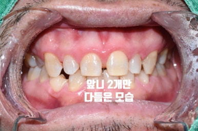 외국인환자의 왜소치 및 치아사이 공간으로 인한 서울 무삭제 라미네이트 & 최소삭제라미네이트 6개 케이스 치아전후사진 이벤트비용 관련 이미지 5