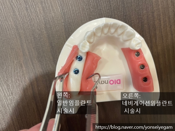 서대문역 가까운 치과 비절개 네비게이션임플란트 소개;덜아프게 빠른 회복위한 관련 이미지 2