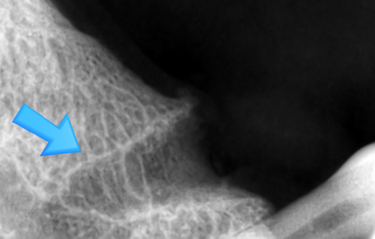 [서울역/치과] 고기 뼈를 씹고 치아가 부러졌어요 관련 이미지 7