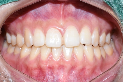 [시청역/광화문]벌어진 앞니 어떻게 치료되었을까요?-부분교정 관련 이미지 1