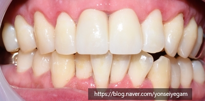 시청역/광화문/서울역 보험 스케일링안내(+치아미백이벤트안내) 관련 이미지 2