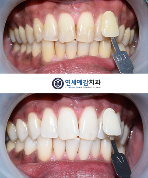 시청역/광화문/서울역 보험 스케일링안내(+치아미백이벤트안내) 관련 이미지 3