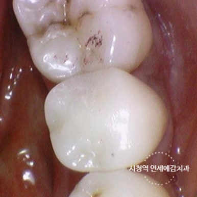 광화문 연세 예감 치과 해외에서도 찾아오는 지르코니아크라운 치료 안내해드려요 관련 이미지 16