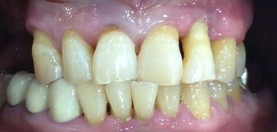 서울 틀니제작, 틀니치료 실제 예입니다. 시청역<연세예감치과> 관련 이미지 9