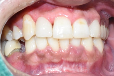 1.송곳니를 다른 앞니 모양 라미네이트로, 2.치아사이 빈공간을 라미네이트로 관련 이미지 4