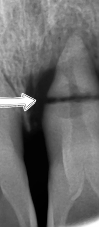 [치과브릿지케이스] 앞니가 너무 많이 흔들려서 발치해야 할 것 같아요 관련 이미지 3