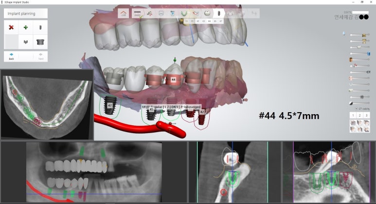 시청역 광화문  최소절개 또는 비절개로 가능한 네비게이션 임플란트 유명한 치과 내비게이션소개드려요 관련 이미지 14