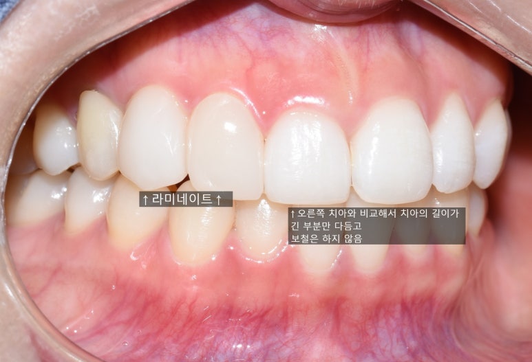 [마포/치과] 까맣게 비어보이는 치아 최소삭제라미네이트 사례. 최소개수로 최대의 효율 관련 이미지 4