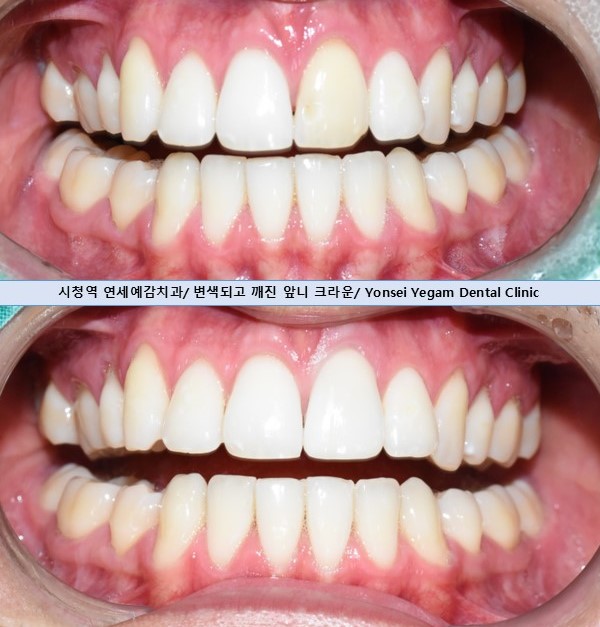 앞니전문으로 외국인들이 찾아오는 연세예감치과에서 알려 드리는 하나만 변색된 앞니의 크라운치료 관련 이미지 1