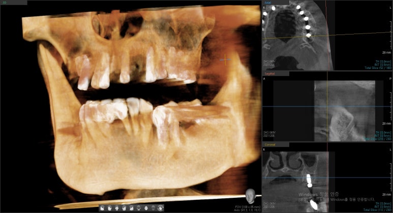앞니 여러개 임플란트 잘하는 치과 서울역치과 실제사진 관련 이미지 19