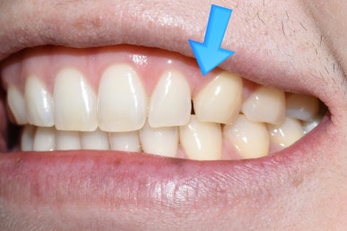 서울시청역치과/ 벌어진 앞니 치아 치료/ 왜소치, 다이아스테마 등/레진, 라미네이트, 부분교정 비교 관련 이미지 10