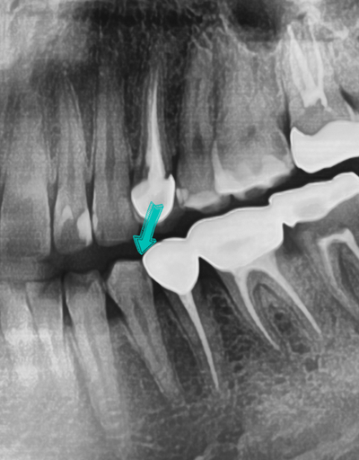 Q&A)충치, 꼭 치료해야 하나요?? 관련 이미지 1